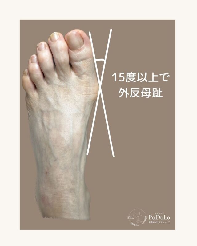 外反母趾は進行性の足の病気です
↪︎ @podolo_footcare.nuse 

放置して悪化すると、
最終的には手術しか選択肢がなくなることも。
ですが、手術をしても元通りの生活に戻れるとは限りません。 

実際に手術を経験された方から、
『手術しないで済むなら、そうした方がいい。守ってあげて』
と伝えられたことは、今も心に残っています。 

外反母趾は、多くの方が
『いつからこうなったかわからない』とおっしゃいます。
それだけ日常で足に無関心になりがちなんです。

痛みがなくても放置してしまうと、
足という“体の土台”が不安定になり、
転倒や骨折、さらには寝たきりのリスクにも
つながる可能性があります。 

だからこそ、【大切なのは進行を遅らせること】
フットケアで全ての外反母趾が治るとは言えませんが、
進行を遅らせるお手伝いはできます。 

もし、少しでも『外反母趾かも？』
と不安に思ったら、まずはご相談ください。
足元の健康を守るため、一緒にケアを始めてみましょう。

#フットケアpodolo #外反母趾改善 #足のトラブル #足が痛い